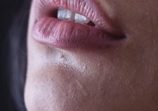 Aumento de labios en Sevilla